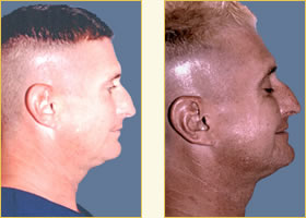 Otoplasty
