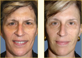 Sculptra Skin Filler
