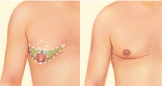 FTM GRS mastectomy GRS mastectomy surgical image