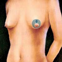Puckering Of Skin