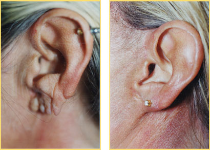 Before and After Earlobe