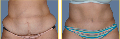 Abdominoplasty (Tummy Tuck)