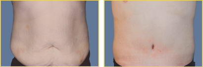 Before and After Abdominoplasty