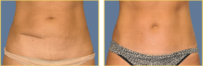 Abdominoplasty (Tummy Tuck)