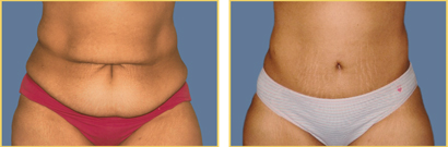 Abdominoplasty Before and After Abdominoplasty