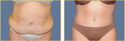 Abdominoplasty (Tummy Tuck)