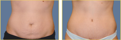 Abdominoplasty (Tummy Tuck)