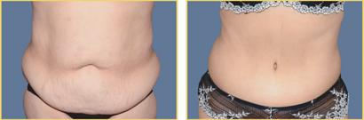 Abdominoplasty (Tummy Tuck)