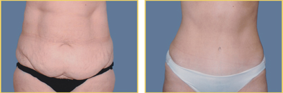 Abdominoplasty (Tummy Tuck)