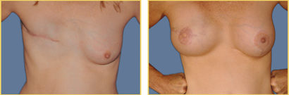 Breast Reconstruction