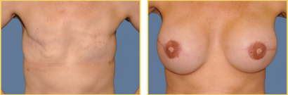Before and After Breast Reconstruction