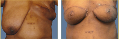 Breast Reconstruction