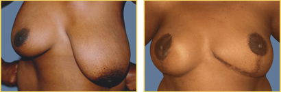 Breast Reconstruction