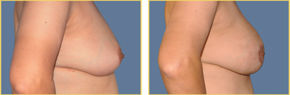 Before and After Breast Reconstruction