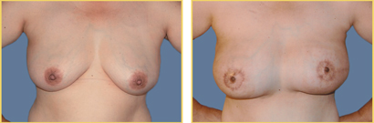 Breast Reconstruction