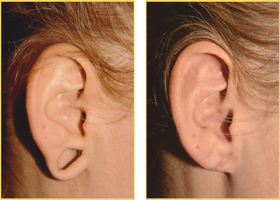 Earlobe Repair Earlobe Repair