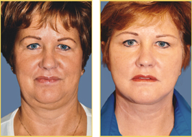 Before and After Facelift