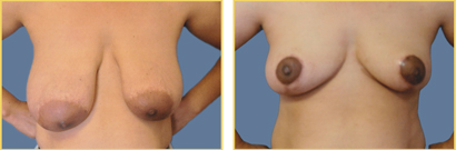 Anchor Incision Mastopexy