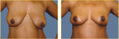Before and After Anchor Mastopexy