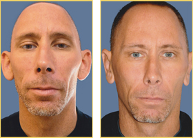 Before and After Otoplasty