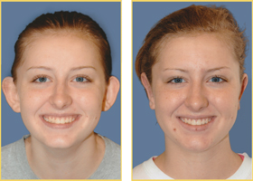 Before and After Otoplasty