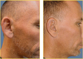 Before and After Otoplasty
