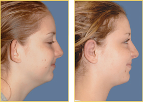 Before and After Otoplasty