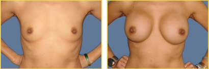 Before and After Augmentation