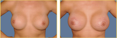 Revision Surgery Before and After Revision Breast Surgery