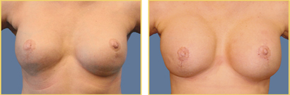 Revision Surgery Before and After Revision Breast Surgery