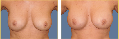 Revision Surgery Before and After Revision Breast Surgery