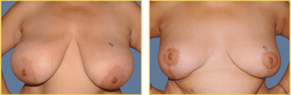 Revision Surgery Before and After Revision Breast Surgery