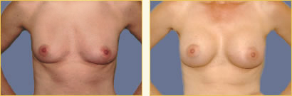 Before and After Augmentation