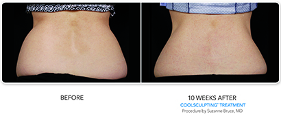 CoolSculpting