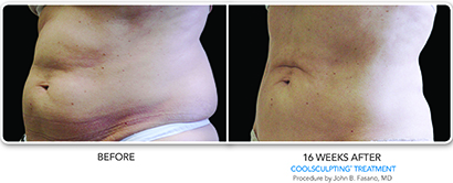 CoolSculpting