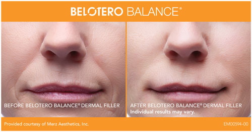 BELOTERO BALANCE