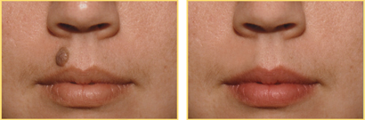 Mole Removal