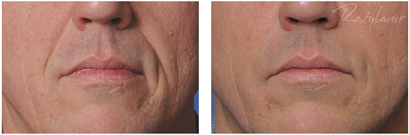 Restylane