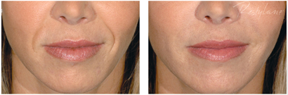 Restylane