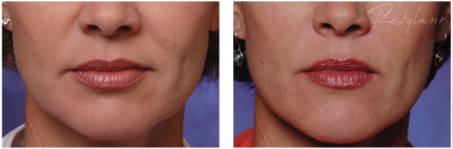 Restylane