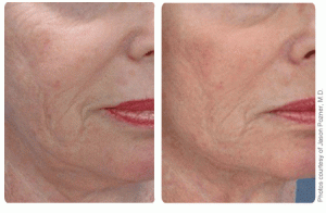 Skin Tightening