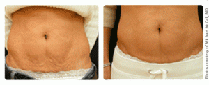 Skin Tightening