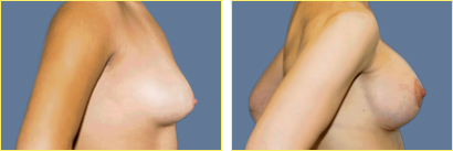 Mastopexy Augmentation - Superior Crescent