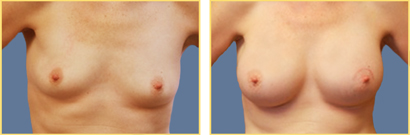 Mastopexy Augmentation: Superior Crescent