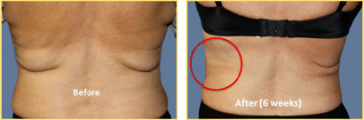 Bilateral Liposuction and ThermiTight only on left side