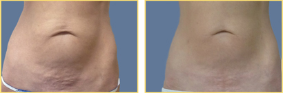 ThermiTight to the lower abdomen