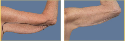 ThermiTight to triceps fat fold and no liposuction