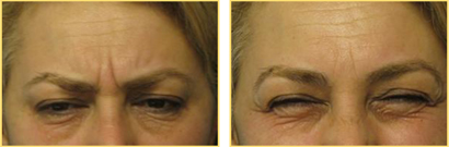After 12 months from a single treatment