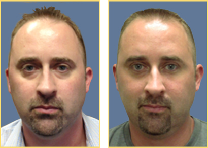 After 22 Days from a single treatment