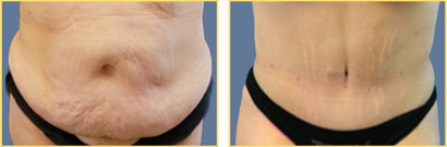 Tummy-Tuck